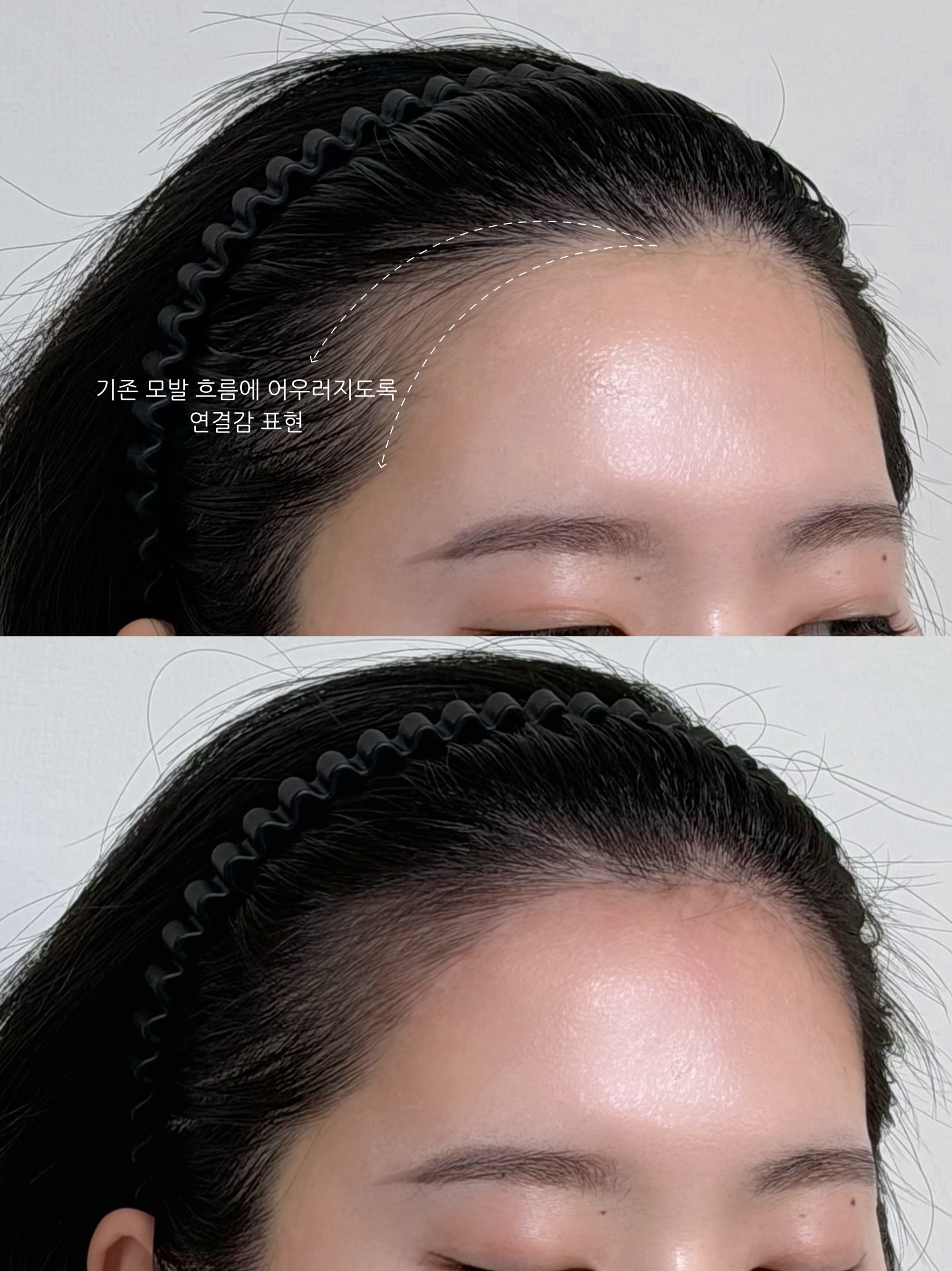 [서울 용산구] M자커버 헤어라인
